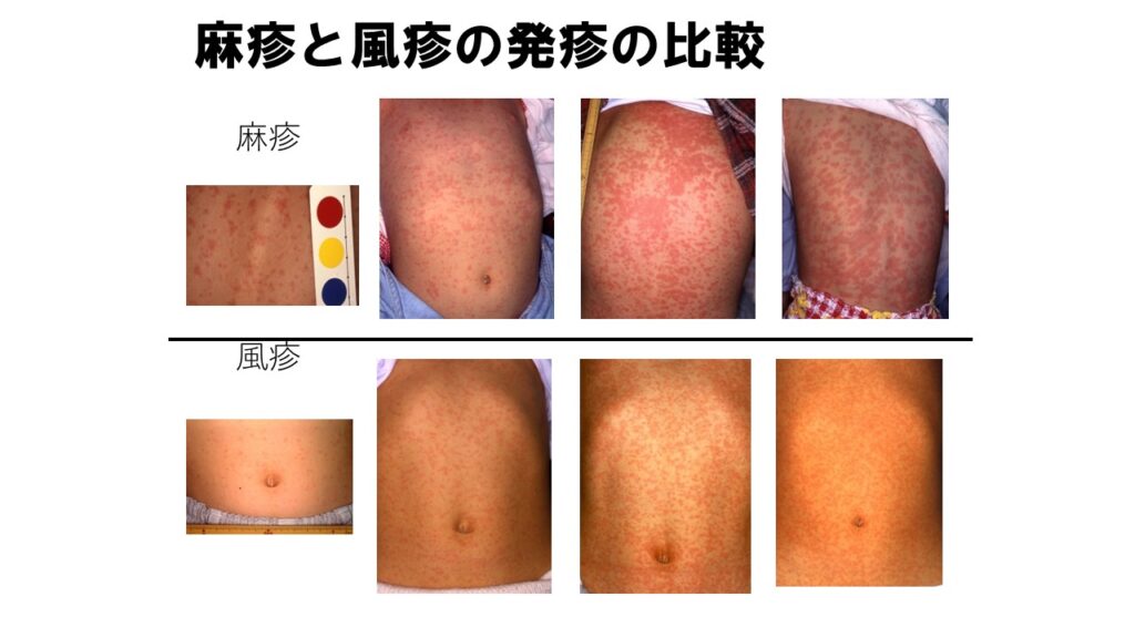 図：麻疹と風疹の発疹の違い